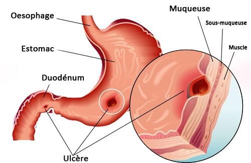 gastro-enterologie pathologie Ulcère de estomac ou du duodénum