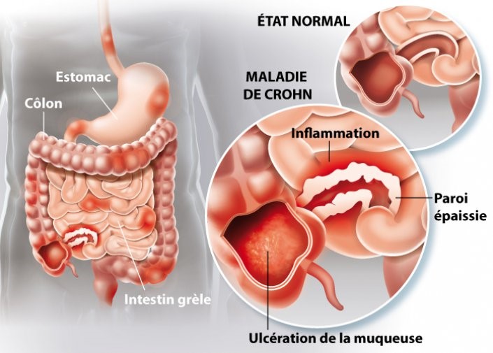 gastro-enterologie pathologie maladie de crohn